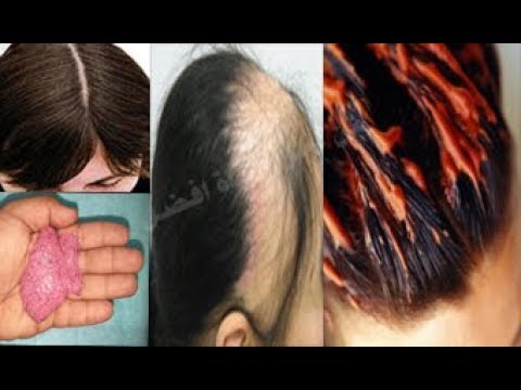 شاهد  وصفة رهيبة من التراث الهندي لإنبات الشعر