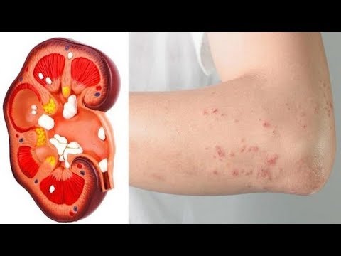 شاهد أول أعراض الفشل الكلوي التي يتجاهلها الكثيرون