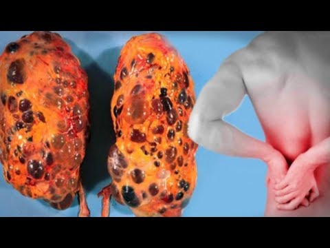 شاهد 8 عادات سيئة تسبب الضرر الخطير للكلى