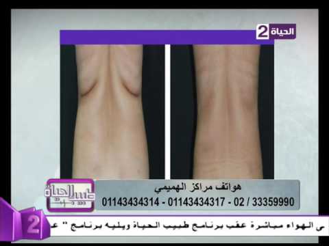 شاهد نتائج شفط الدهون