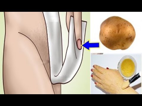 شاهد البطاطس للتخلص الفوري من شعر العانة  