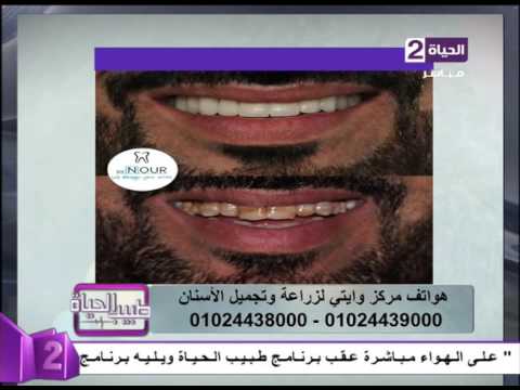 شاهد نتائج مبهرة لحالة بعد تجميل الأسنان